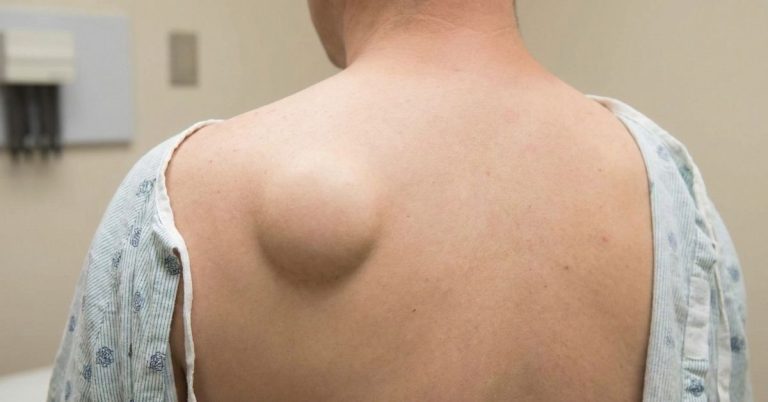 Lipome du dos