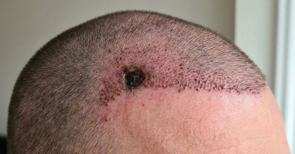 nécrose après une greffe de cheveux