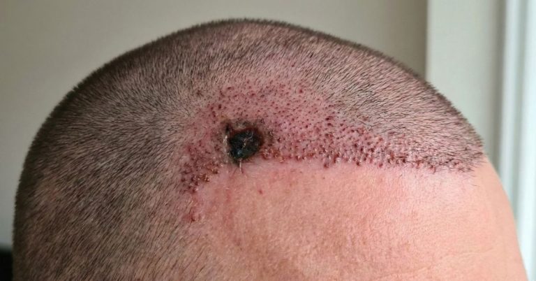 nécrose après une greffe de cheveux