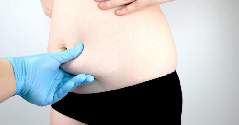 Mini abdominoplastie ou complète comment choisir