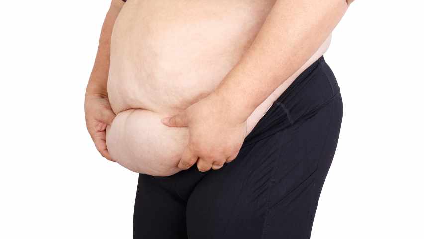 Bodylift après perte de poids massive