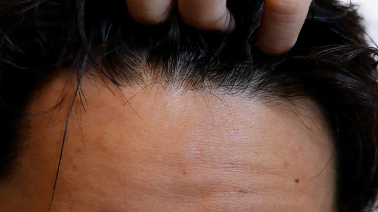 Dermopigmentation du cuir chevelu