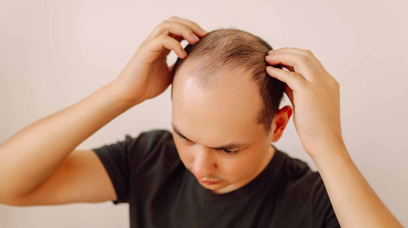 Quelles sont les causes d'une perte de cheveux