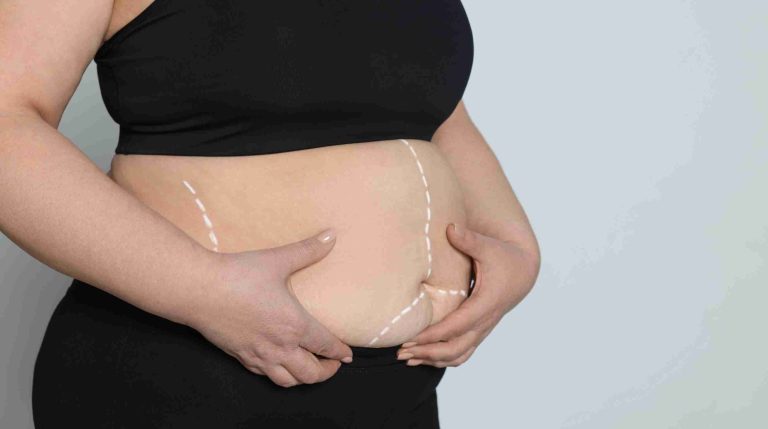 Cicatrice d'abdominoplastie : évolution, soins et conseils
