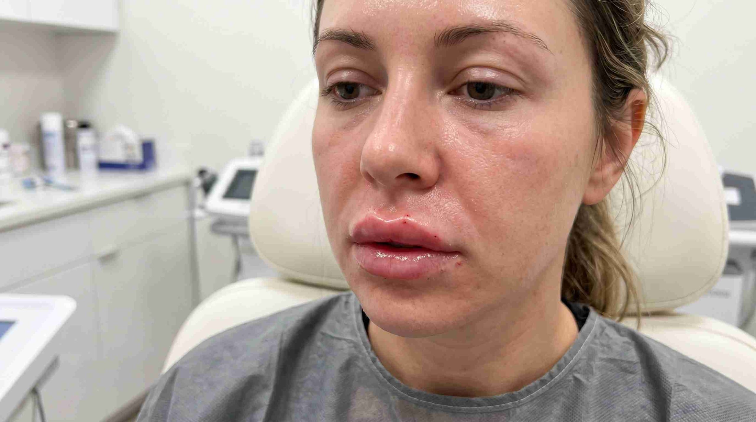 Œdème après injection d'acide hyaluronique : durée normale, évolution