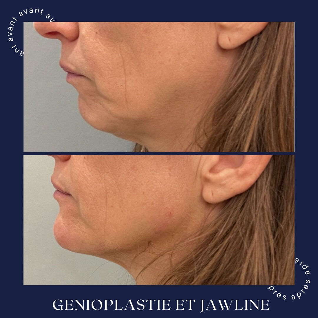 Génioplastie + jawline, 24 mois, Dr Daniel Alimi (photo 1 sur 2)
