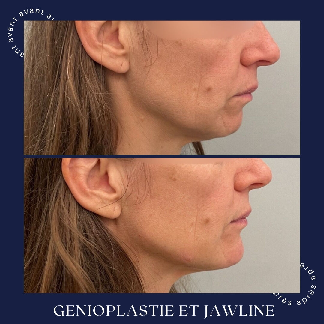 Génioplastie + jawline, 24 mois, Dr Daniel Alimi (photo 2 sur 2)