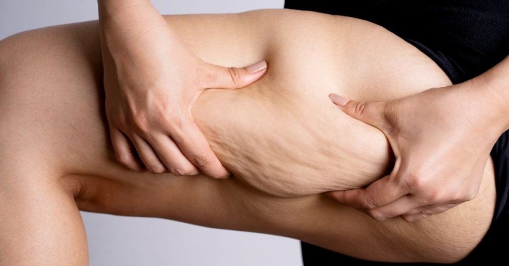 À quoi est due la cellulite ?