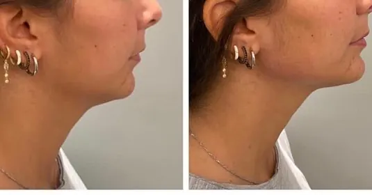 Jawline contouring, patiente de 38 ans, Dr Daniel Alimi (photo 1 sur 2)