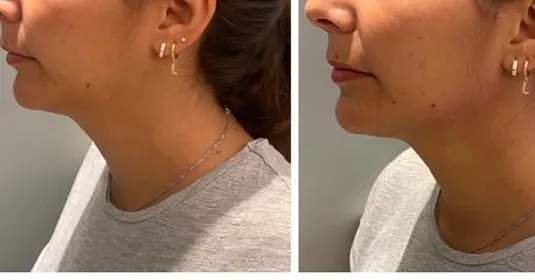 Jawline contouring, patiente de 38 ans, Dr Daniel Alimi (photo 2 sur 2)