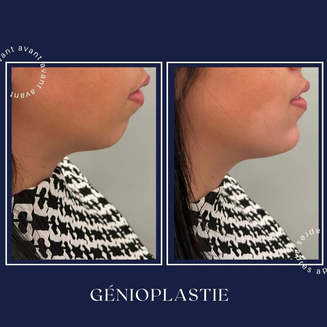 Avant / après, génioplastie médicale (acide hyaluronique), Dr Daniel Alimi