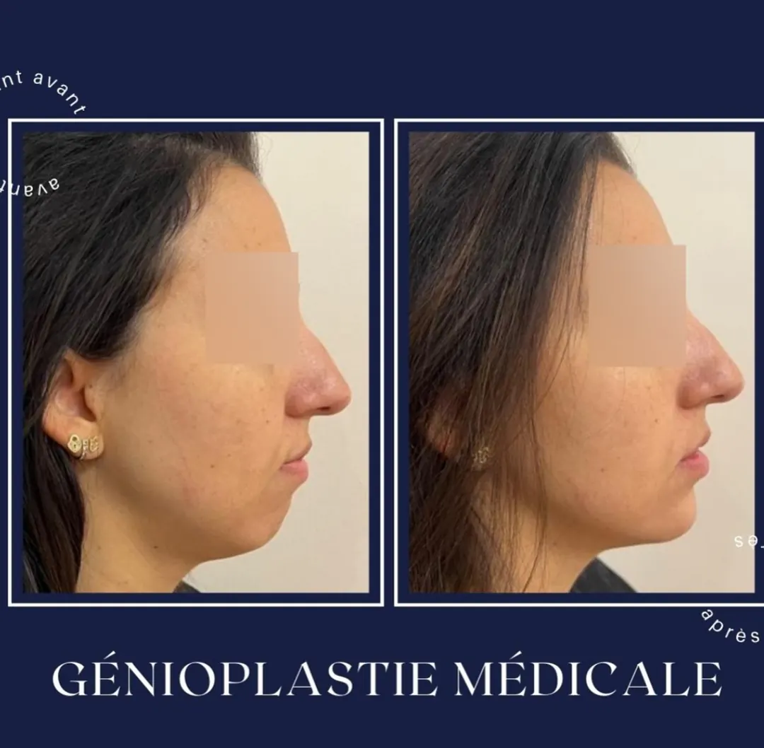 Avant / après, génioplastie médicale (acide hyaluronique), Dr Daniel Alimi (photo 1 sur 2)