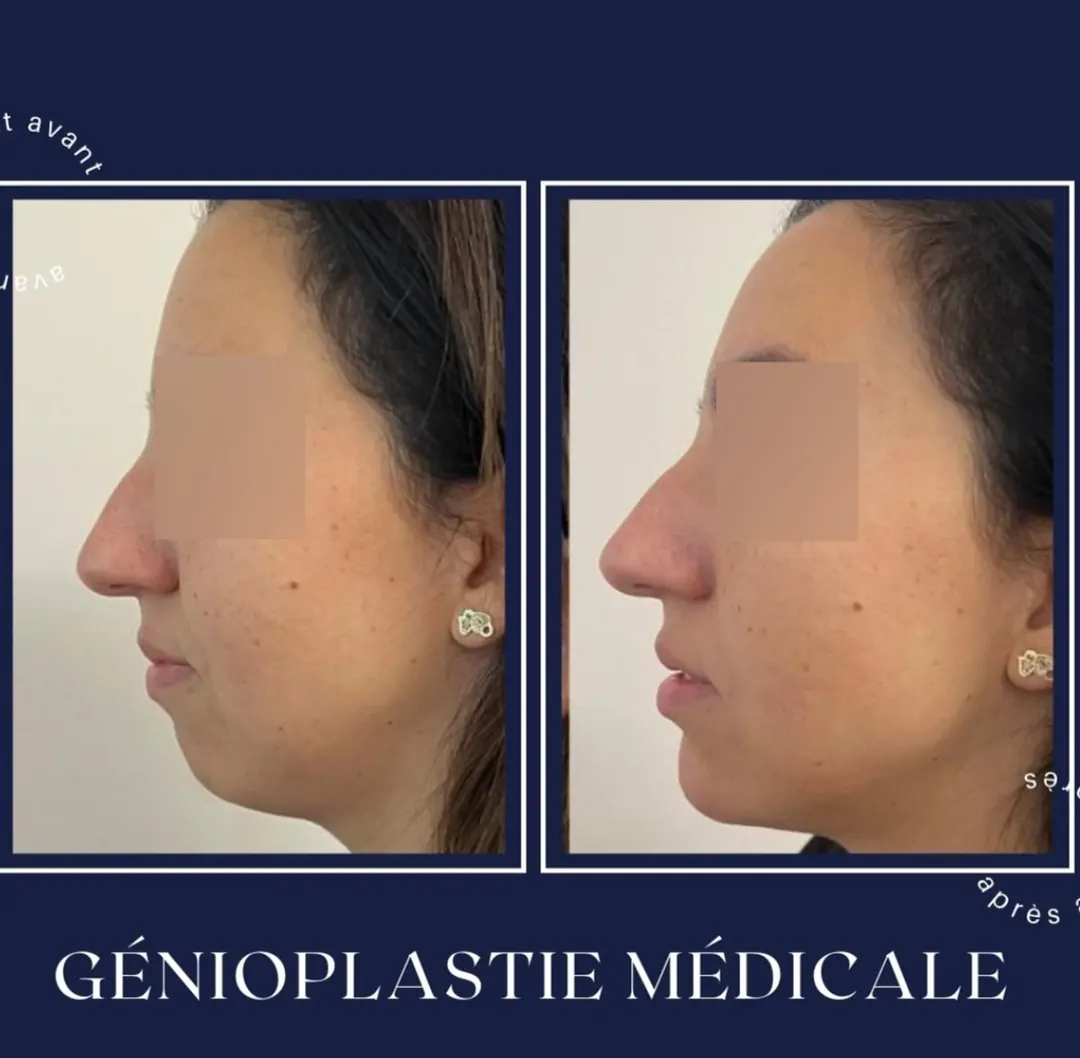Avant / après, génioplastie médicale (acide hyaluronique), Dr Daniel Alimi (photo 2 sur 2)