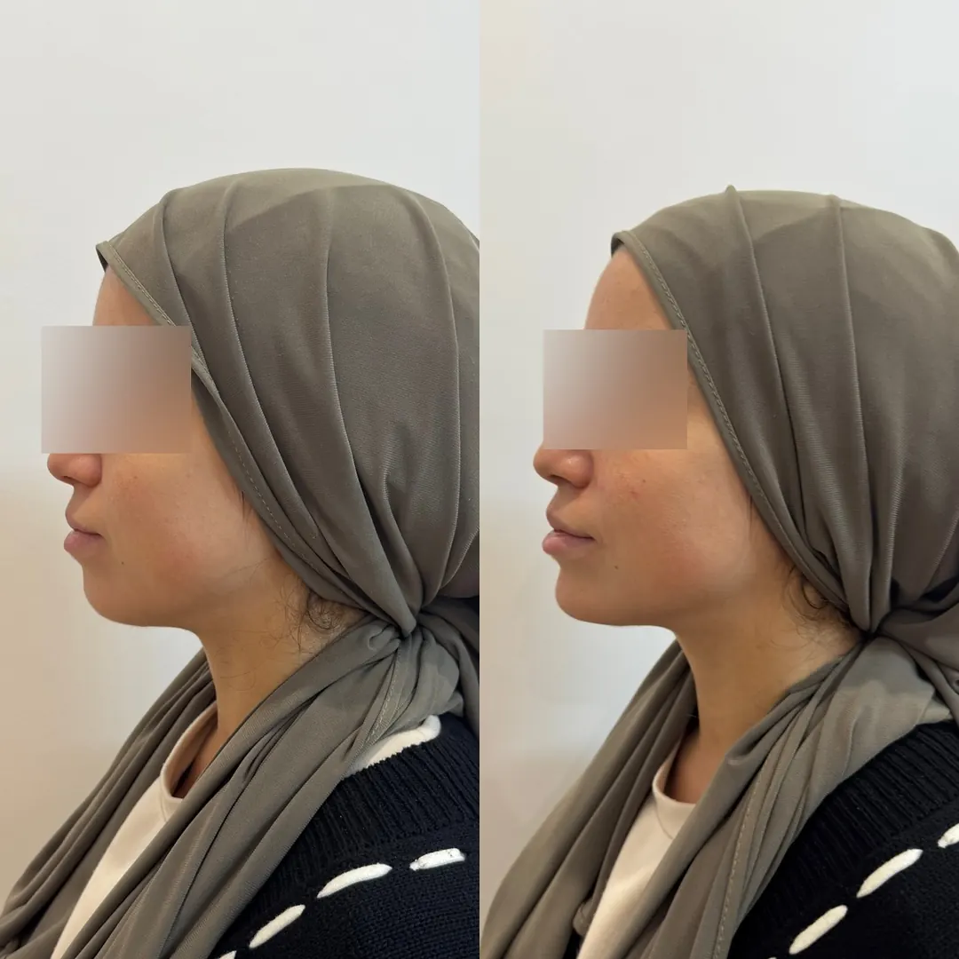 Avant / après, génioplastie médicale (acide hyaluronique), Dr Daniel Alimi