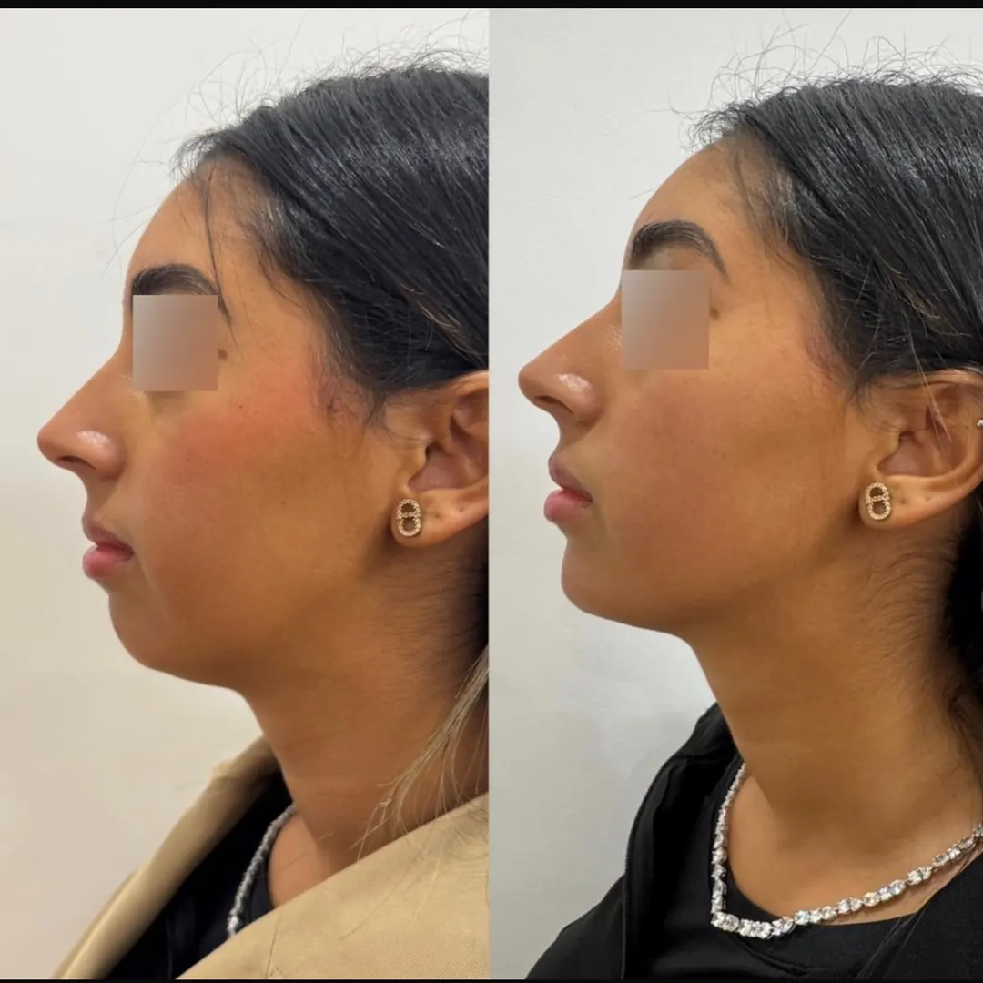 Génioplastie médicale, 10 min, 12-18 mois, Dr Daniel Alimi
