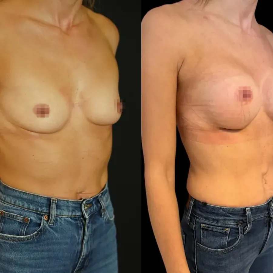 Avant/après Augmentation mammaire, Dr Nathanel Edery, Clinique Spontini Paris 16e