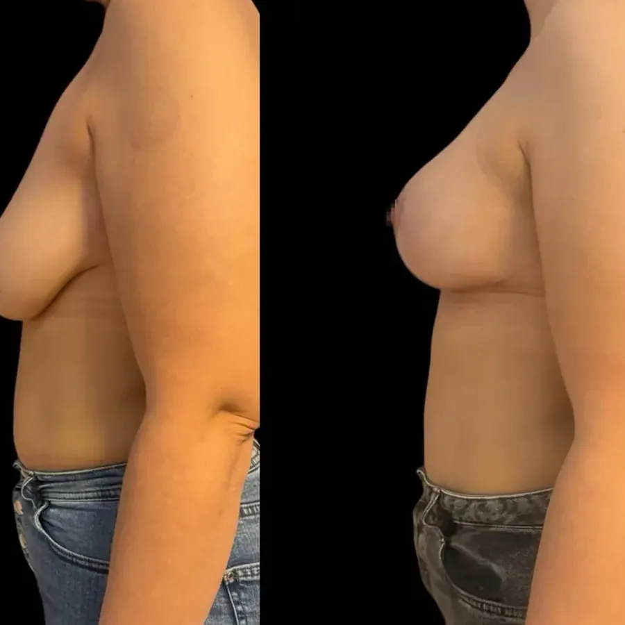 Avant/après Augmentation mammaire, Dr Nathanel Edery, Clinique Spontini Paris 16e