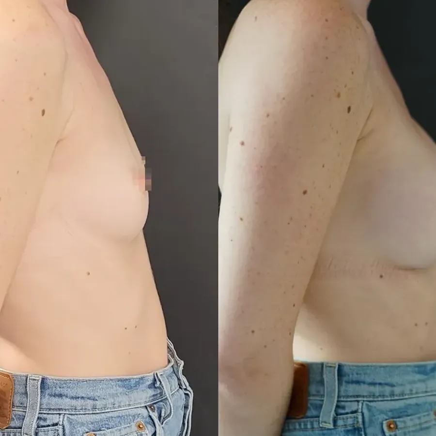 Avant/après Augmentation mammaire, Dr Nathanel Edery, Clinique Spontini Paris 16e