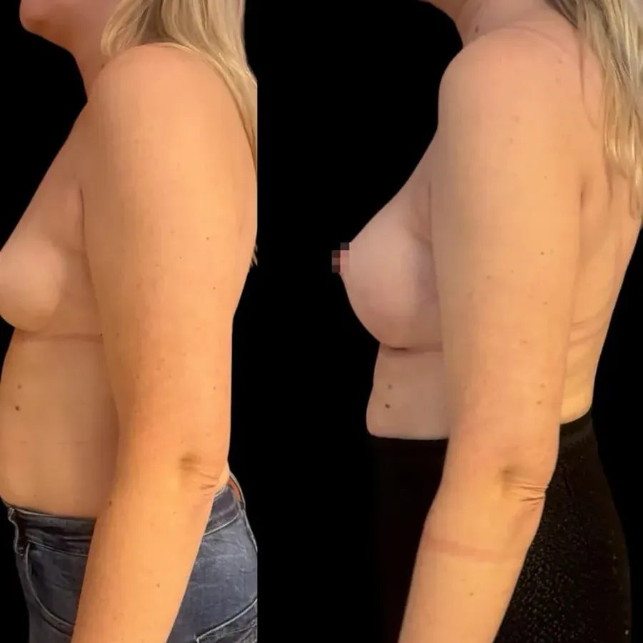 Avant/après Augmentation mammaire, Dr Nathanel Edery, Clinique Spontini Paris 16e