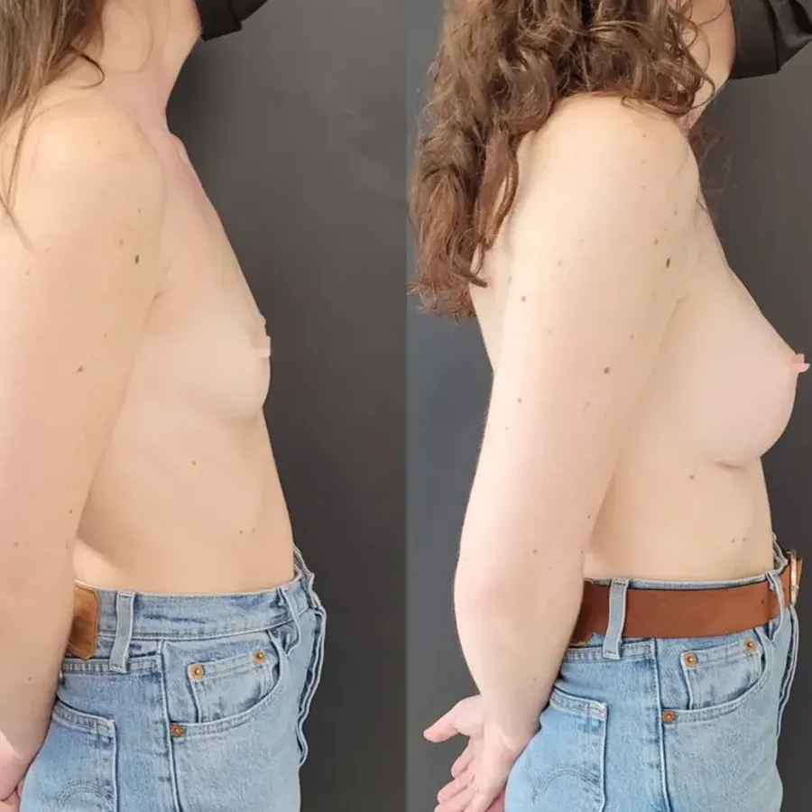 Avant/après Augmentation mammaire, Dr Nathanel Edery, Clinique Spontini Paris 16e