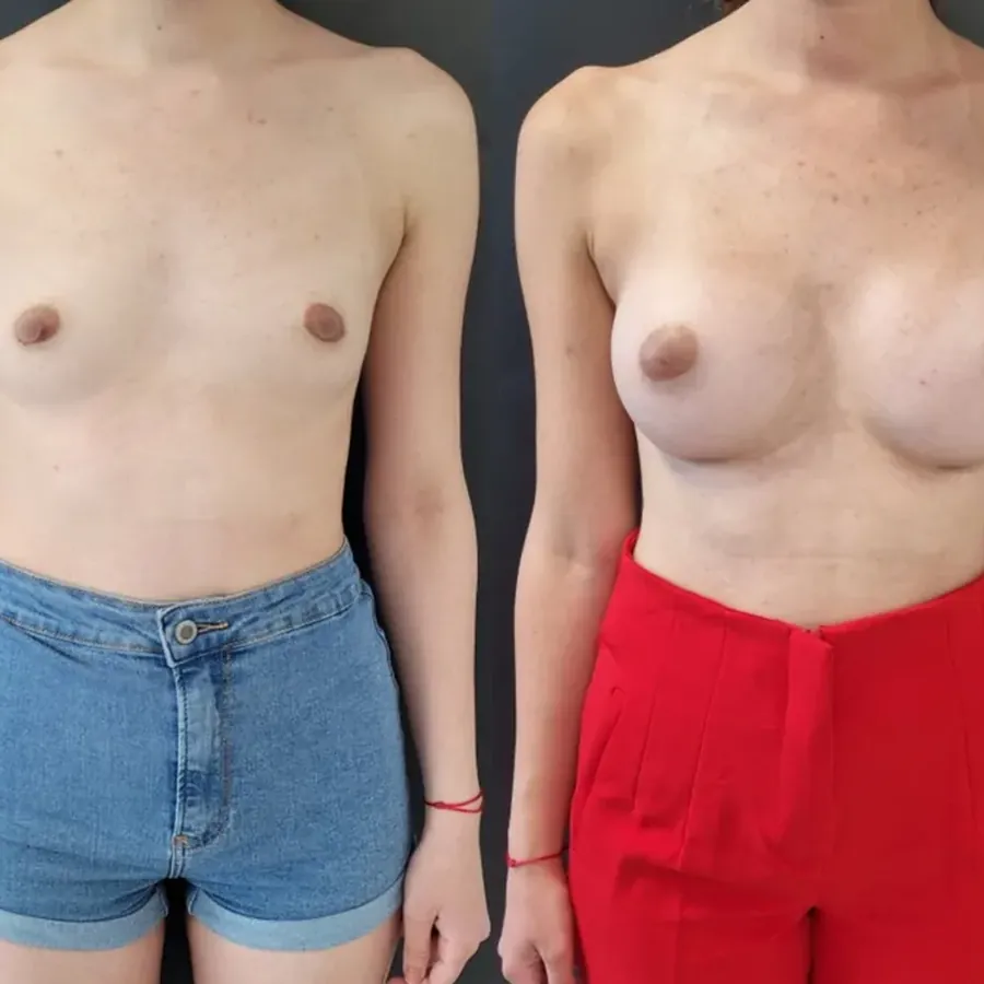 Avant/après Augmentation mammaire, Dr Nathanel Edery, Clinique Spontini Paris 16e