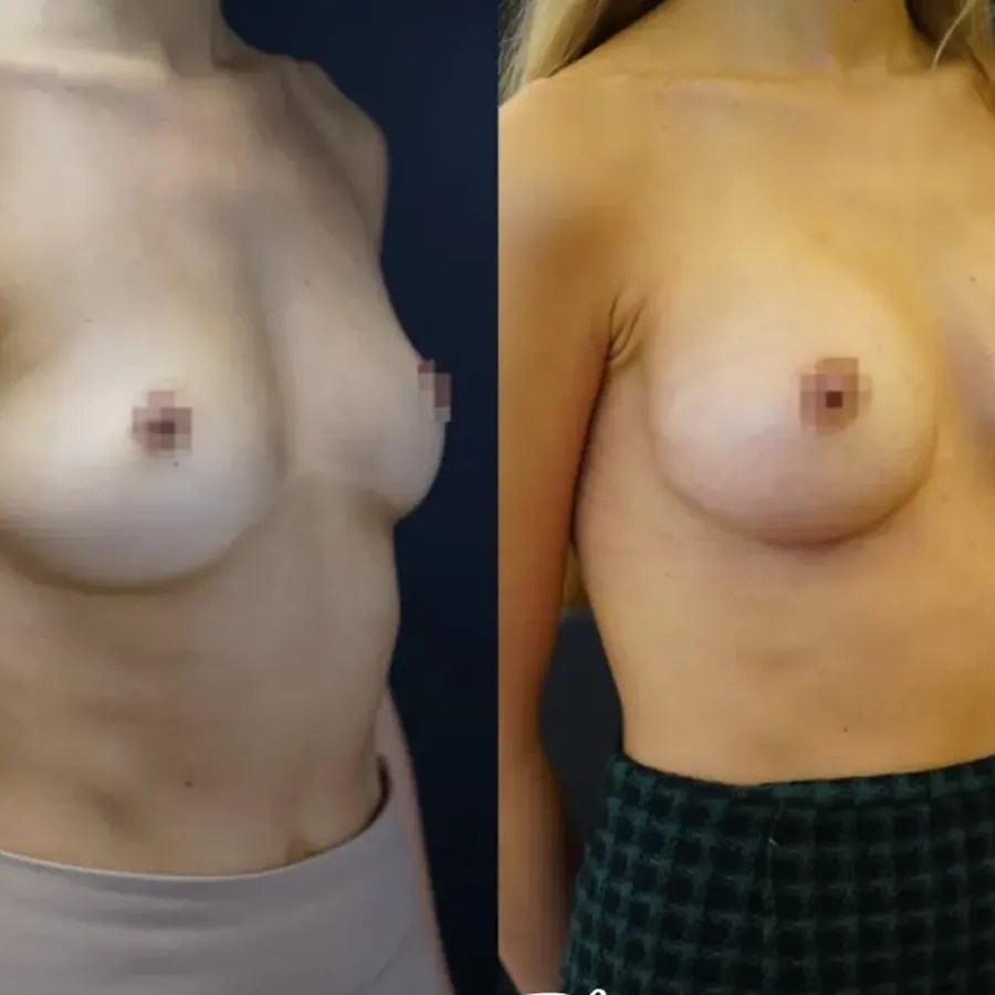 Avant/après Augmentation mammaire, Dr Nathanel Edery, Clinique Spontini Paris 16e