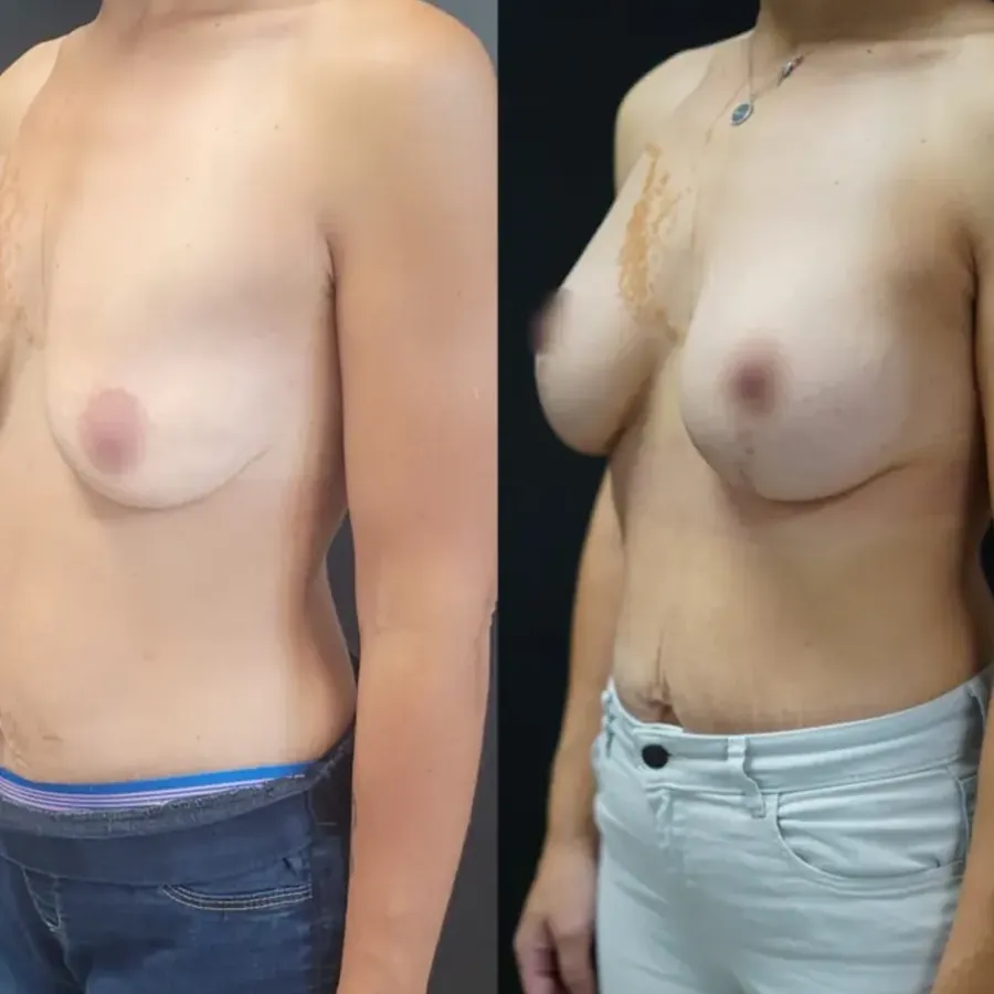 Avant/après Augmentation mammaire, Dr Nathanel Edery, Clinique Spontini Paris 16e