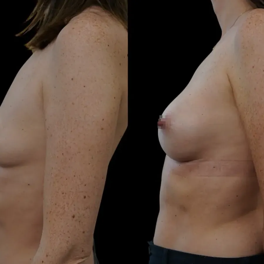 Avant/après Augmentation mammaire, Dr Nathanel Edery, Clinique Spontini Paris 16e