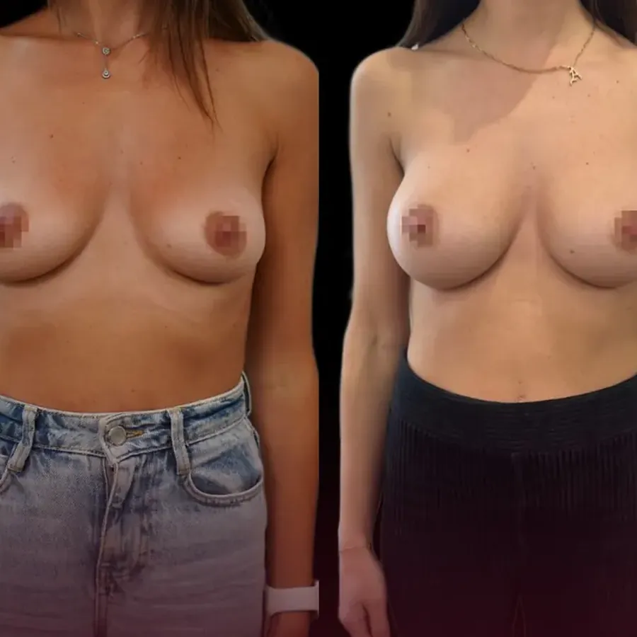 Avant/après Augmentation mammaire, Dr Nathanel Edery, Clinique Spontini Paris 16e