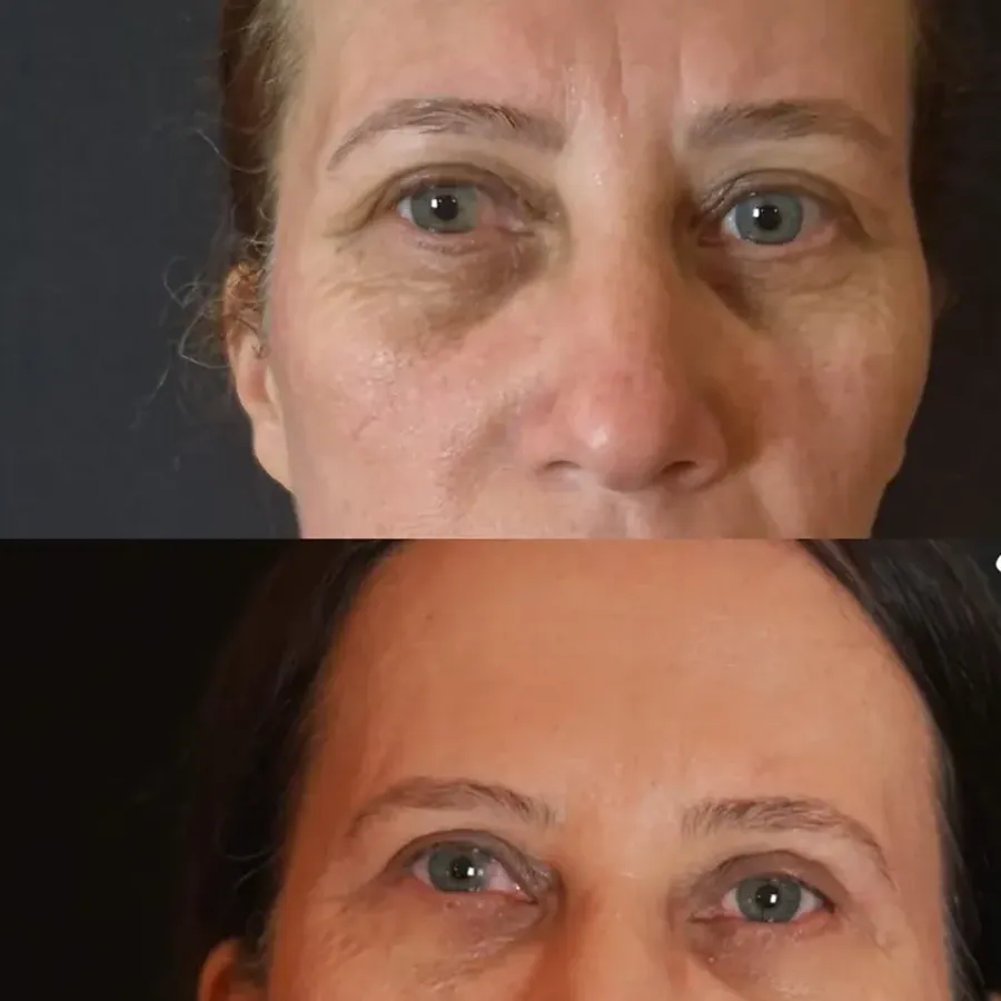 Avant/après Blépharoplastie des 4 paupières, Dr Nathanel Edery, Clinique Spontini Paris 16e (vue 1)