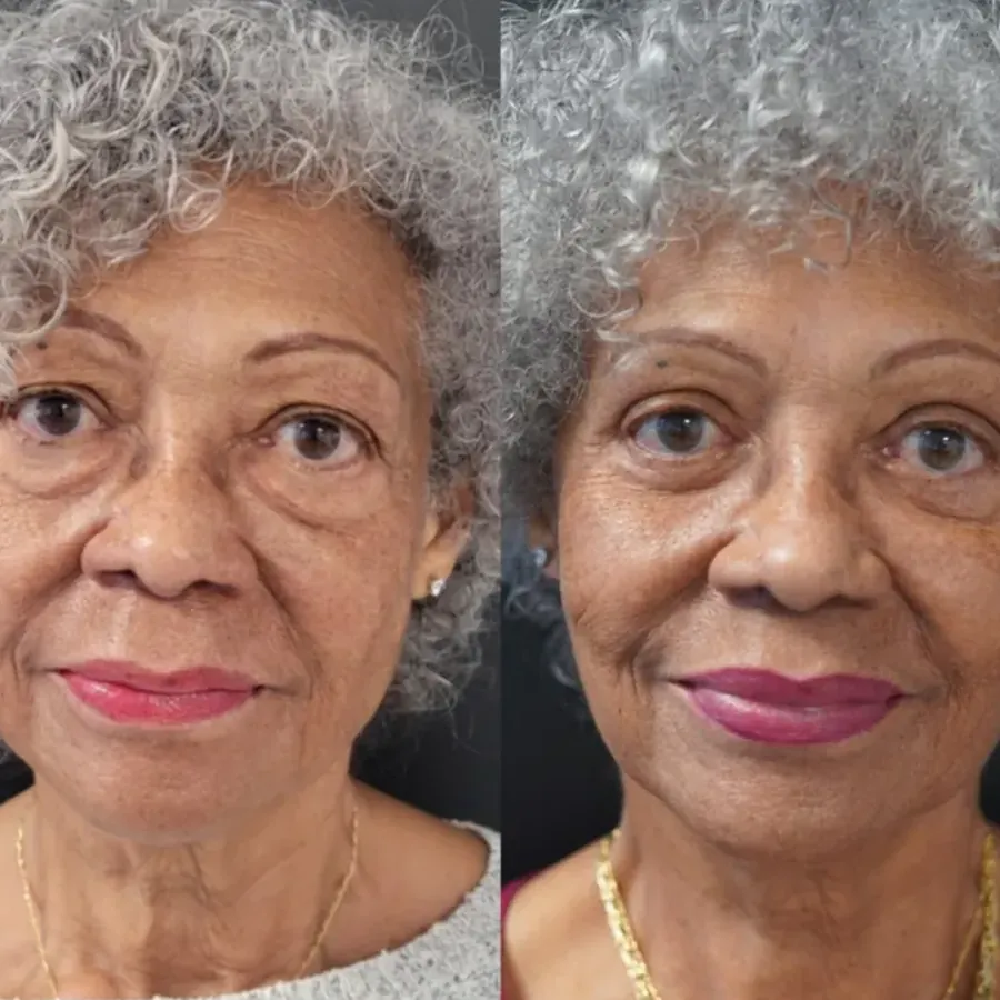 Avant/après Blépharoplastie des 4 paupières, Dr Nathanel Edery, Clinique Spontini Paris 16e