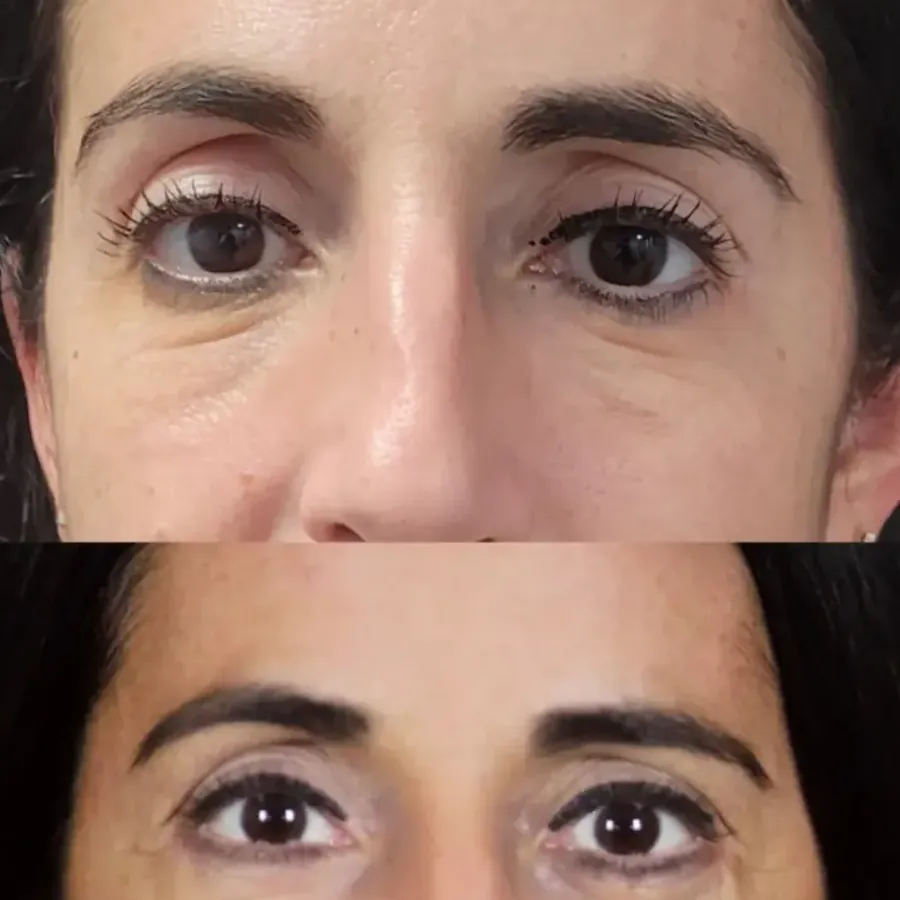 Avant/après Blépharoplastie inférieure, jeune patiente, Dr Nathanel Edery, Clinique Spontini Paris 16e