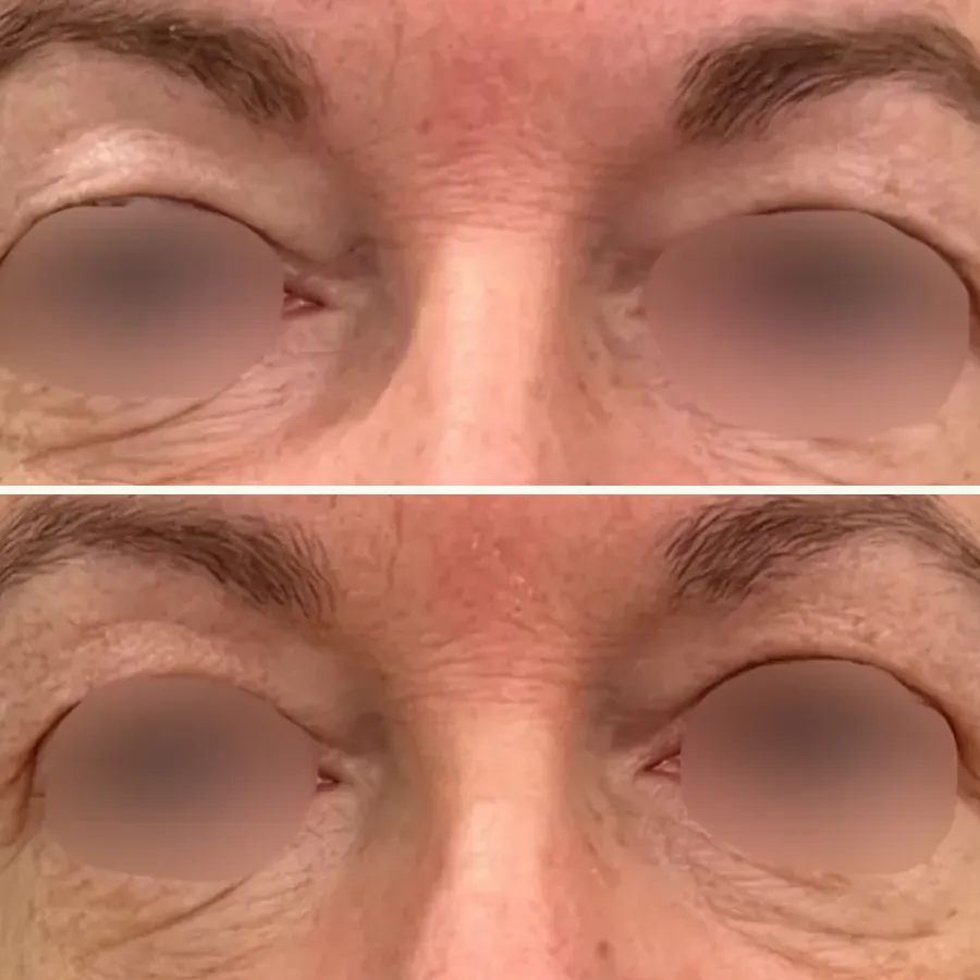Avant/après Blépharoplastie médicale (Plexr), paupières supérieures, Dr Daniel Alimi, Clinique Spontini Paris 16e