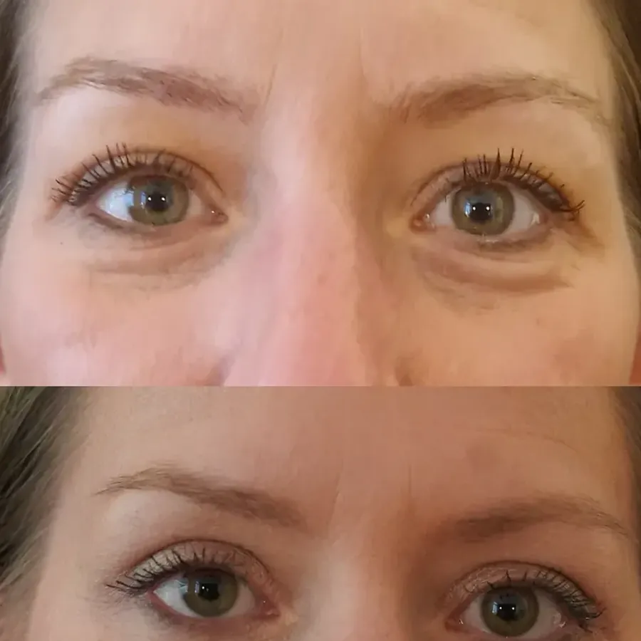 Avant/après Blépharoplastie supérieure, Dr Nathanel Edery, Clinique Spontini Paris 16e