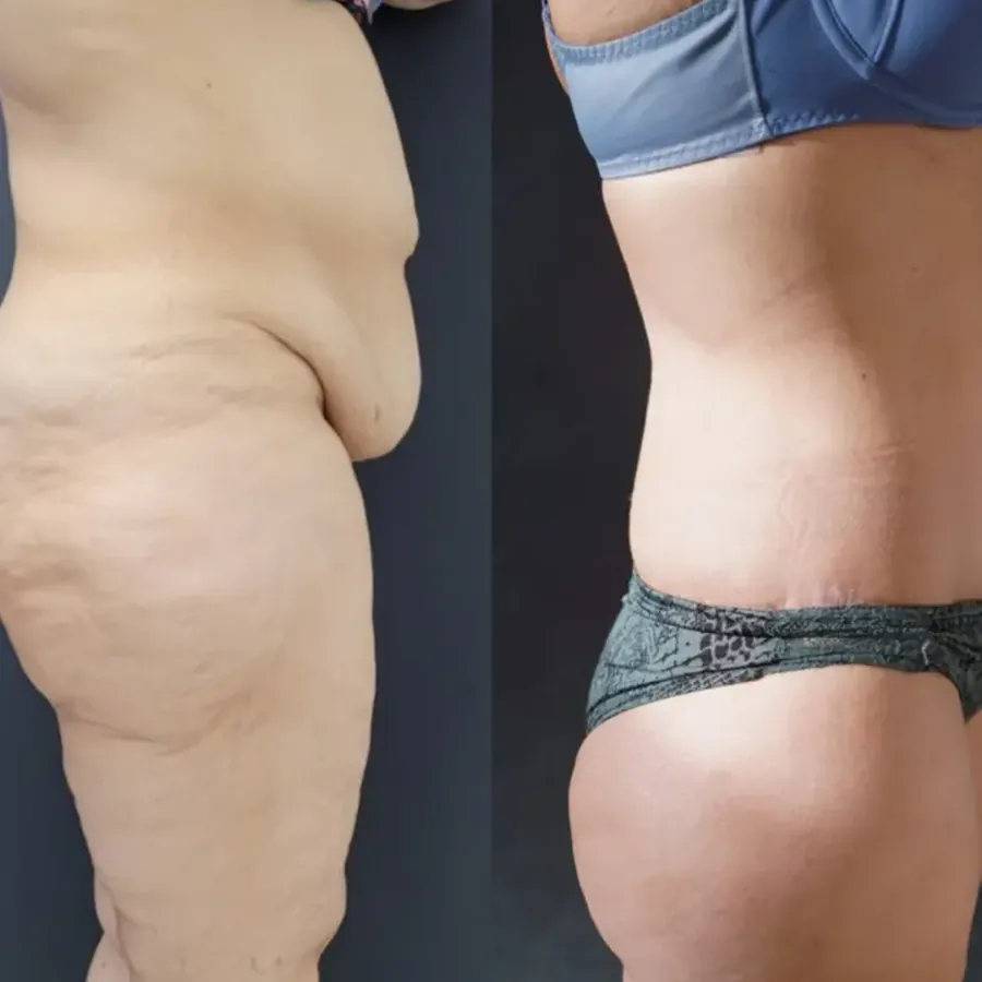 Avant/après Bodylift 1 an après bypass (-50 kg), Dr Nathanel Edery, Clinique Spontini Paris 16e (vue 1)