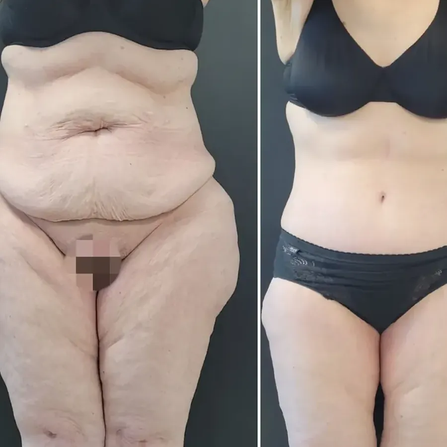 Avant/après Bodylift inférieur après amaigrissement massif, 1 mois, Dr Nathanel Edery, Clinique Spontini Paris 16e (vue 1)