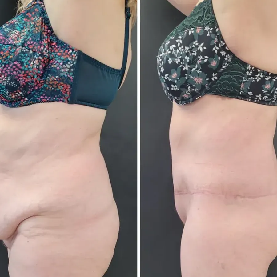 Avant/après Bodylift, résultat à 4 mois, Dr Nathanel Edery, Clinique Spontini Paris 16e (vue 1)