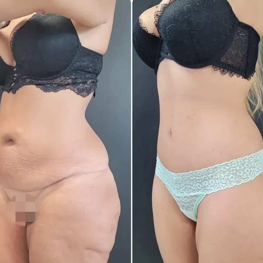 Avant/après Bodylift, résultat à 5 mois, Dr Nathanel Edery, Clinique Spontini Paris 16e (vue 1)