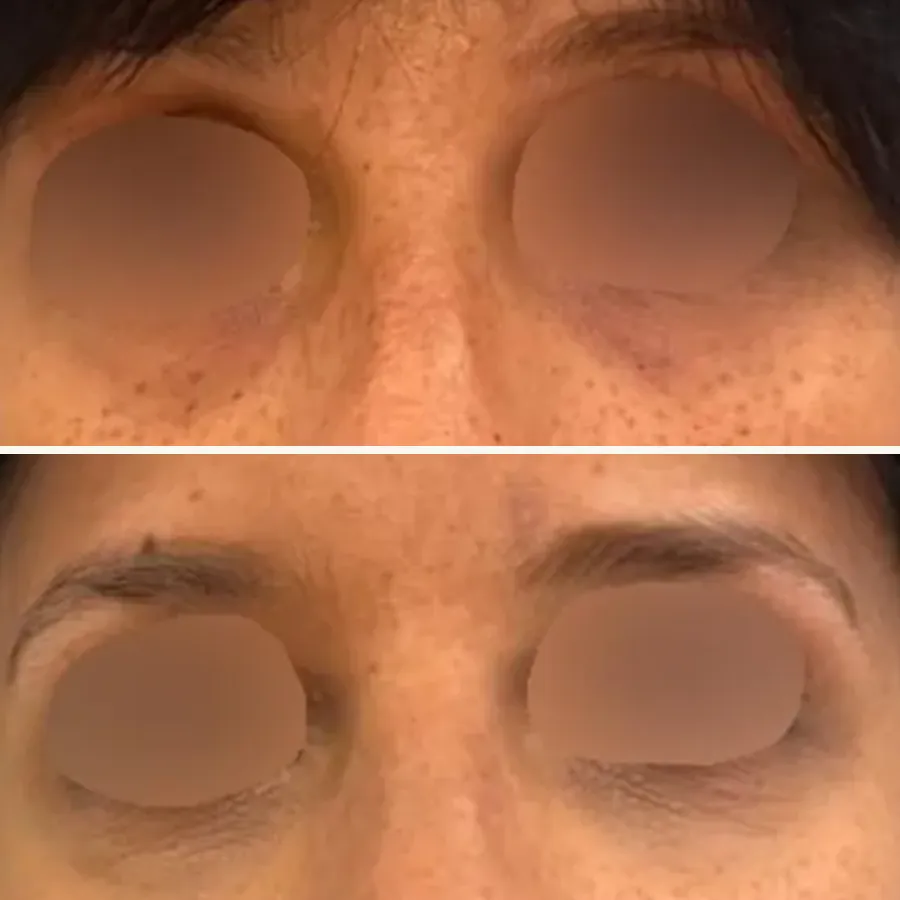 Avant/après Cernes, acide hyaluronique peu réticulé, Dr Daniel Alimi, Clinique Spontini Paris 16e