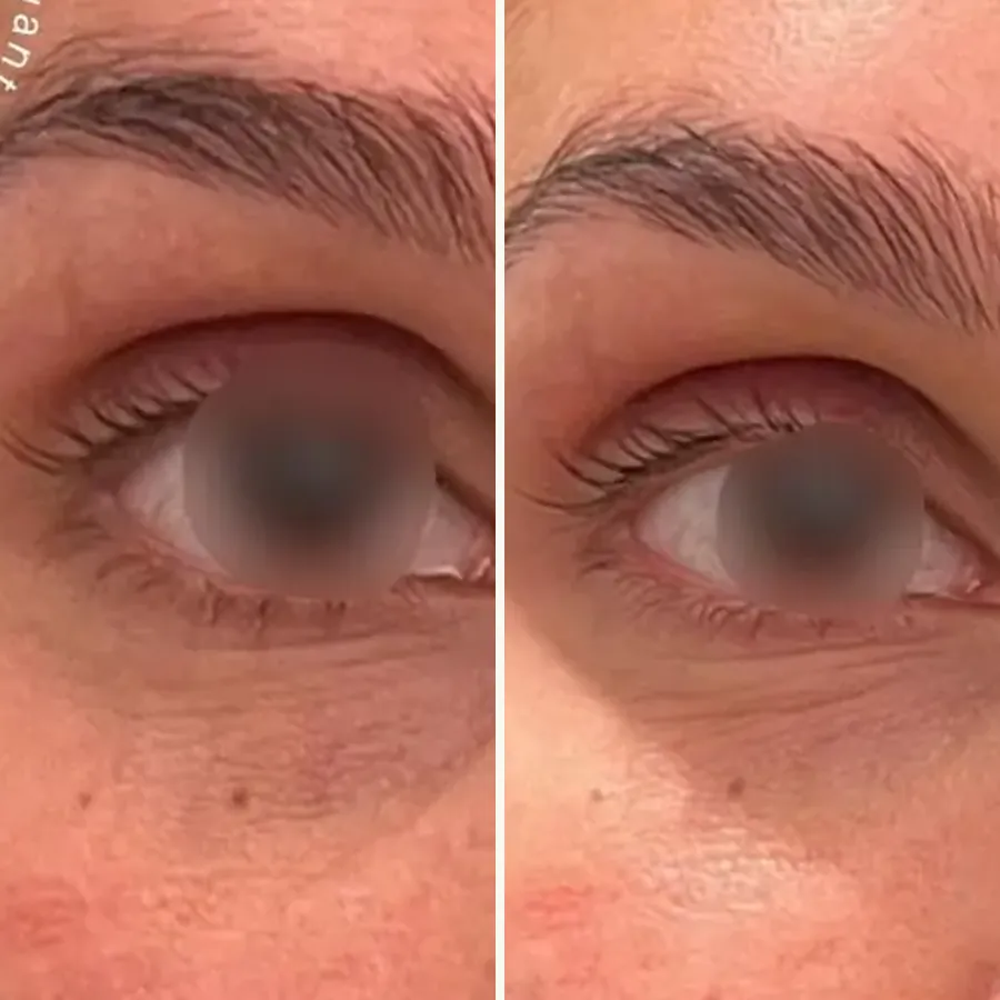 Avant/après Cernes creux, patiente de 30 ans, Dr Daniel Alimi, Clinique Spontini Paris 16e