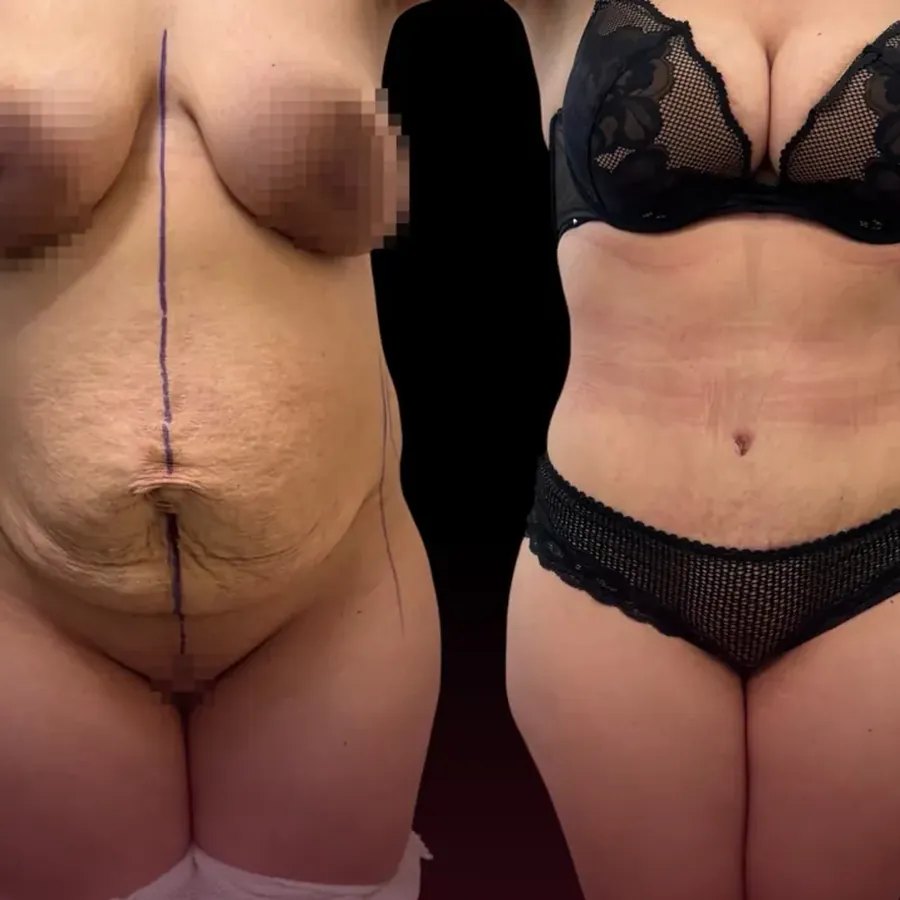 Avant/après Diastasis, 3 mois, Dr Nathanel Edery, Clinique Spontini Paris 16e (vue 1)