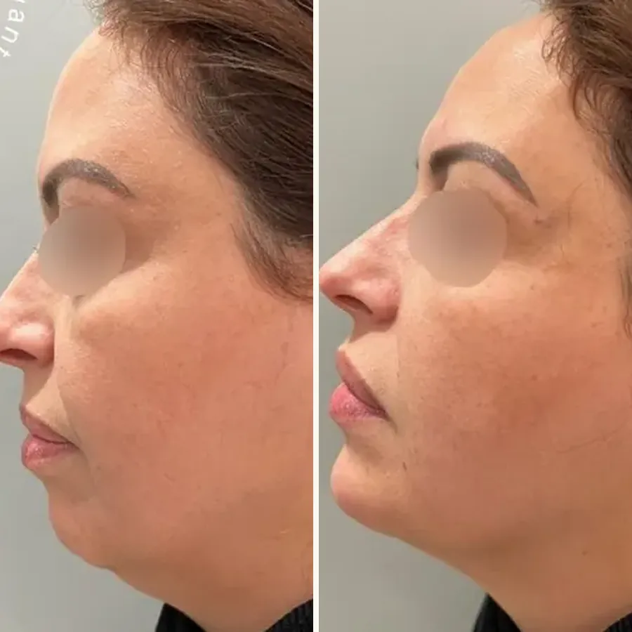 Avant/après Génioplastie et double menton, Dr Daniel Alimi, Clinique Spontini Paris 16e
