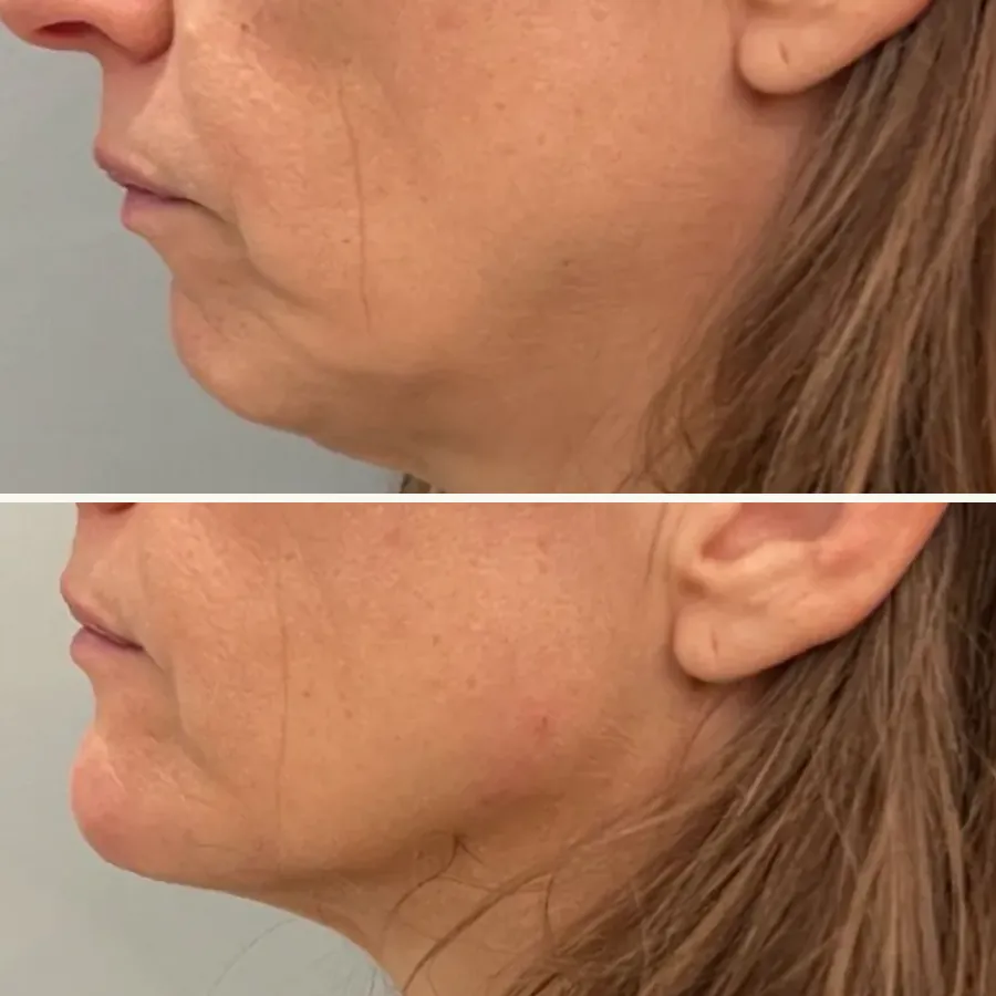 Avant/après Génioplastie + jawline, 24 mois, Dr Daniel Alimi, Clinique Spontini Paris 16e (vue 1)