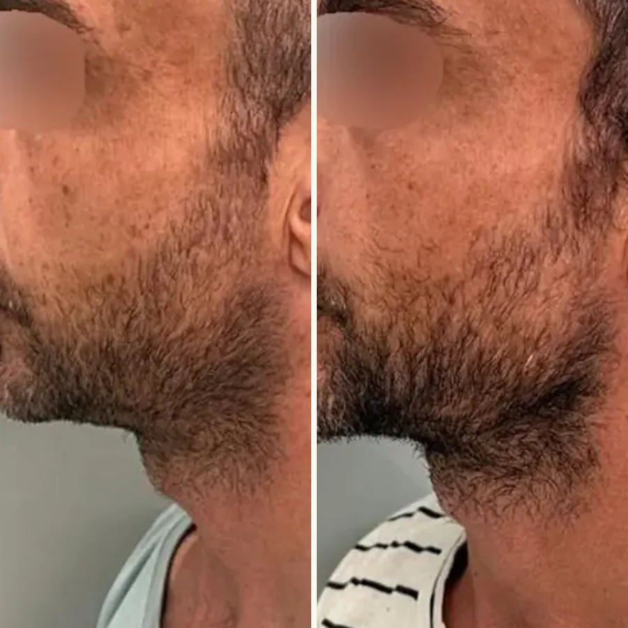 Avant/après Génioplastie + jawline chez l’homme, Dr Daniel Alimi, Clinique Spontini Paris 16e