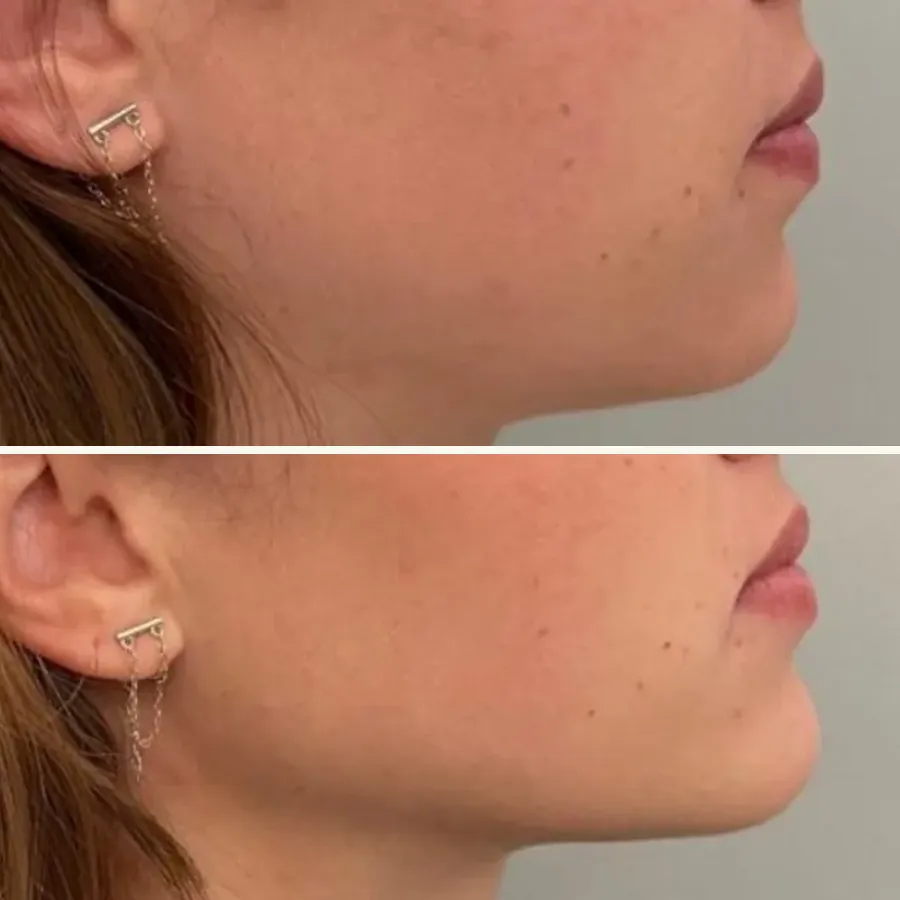 Avant/après Génioplastie + jawline, jeune patiente, Dr Daniel Alimi, Clinique Spontini Paris 16e