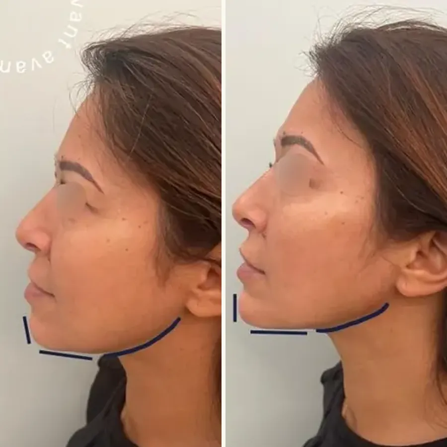 Avant/après Génioplastie + jawline (ovale), Dr Daniel Alimi, Clinique Spontini Paris 16e (vue 1)