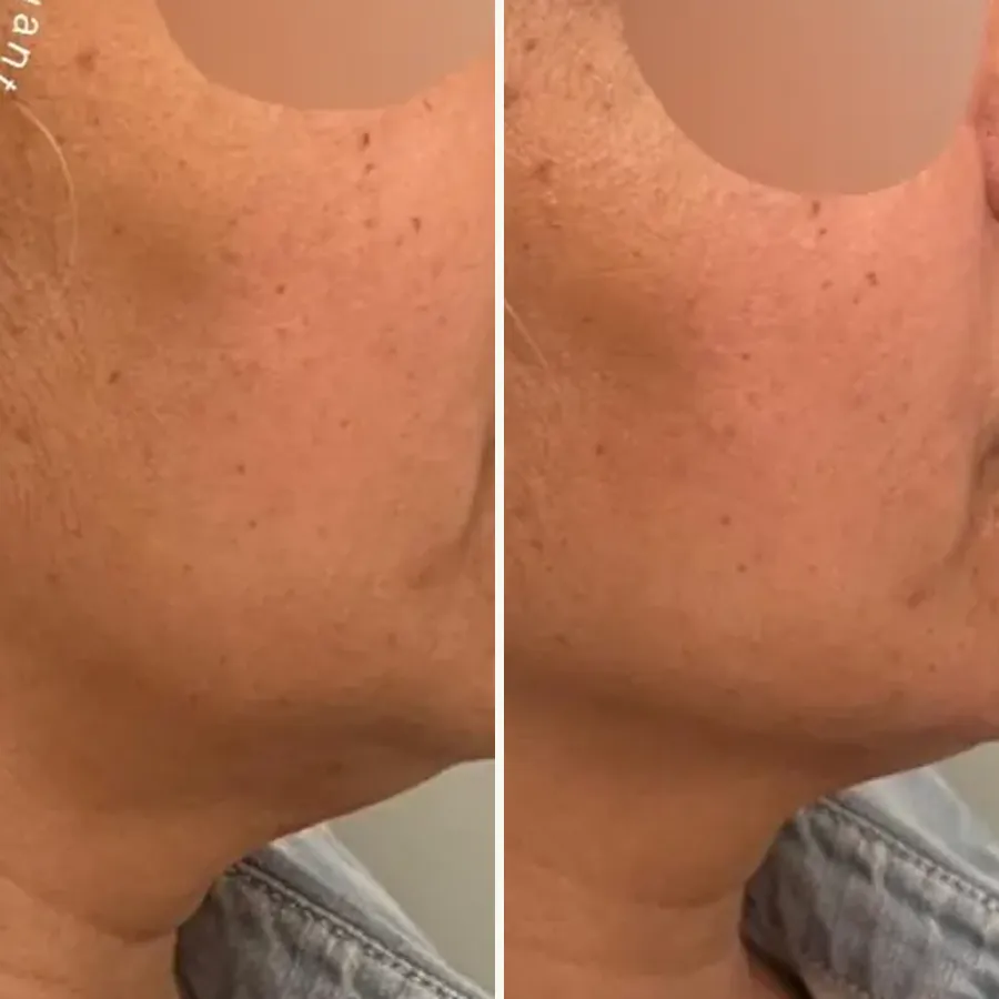 Avant/après Génioplastie + jawline, patiente d’une soixantaine d’années, Dr Daniel Alimi, Clinique Spontini Paris 16e