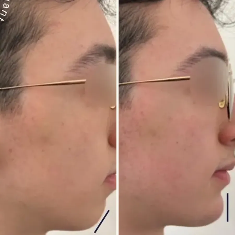 Avant/après Génioplastie médicale chez l’homme, Dr Daniel Alimi, Clinique Spontini Paris 16e