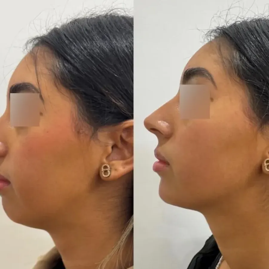 Avant/après Génioplastie médicale, Dr Daniel Alimi, Clinique Spontini Paris 16e