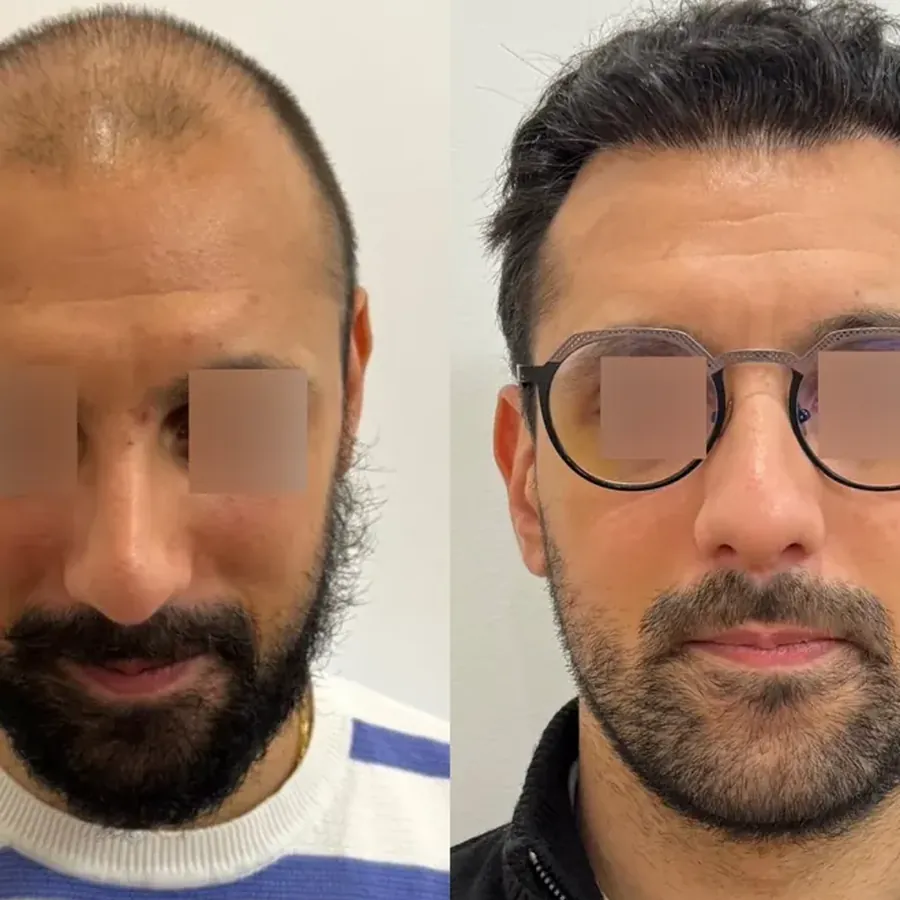 Avant/après Greffe de cheveux FUE, résultat à 8 mois, Dr Daniel Alimi, Clinique Spontini Paris 16e (vue 1)
